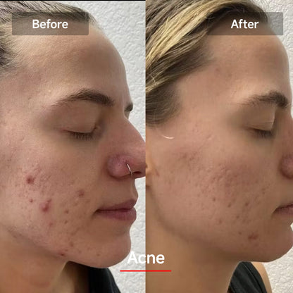 Máscara Facial de Luz LED - DermaLux™