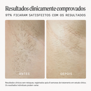 NOOD - Depilador a Laser