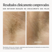 NOOD - Depilador a Laser