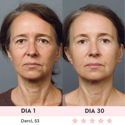 Lift Facial com HIFU – Tecnologia que Ativa o Colágeno e Rejuvenesce o Rosto