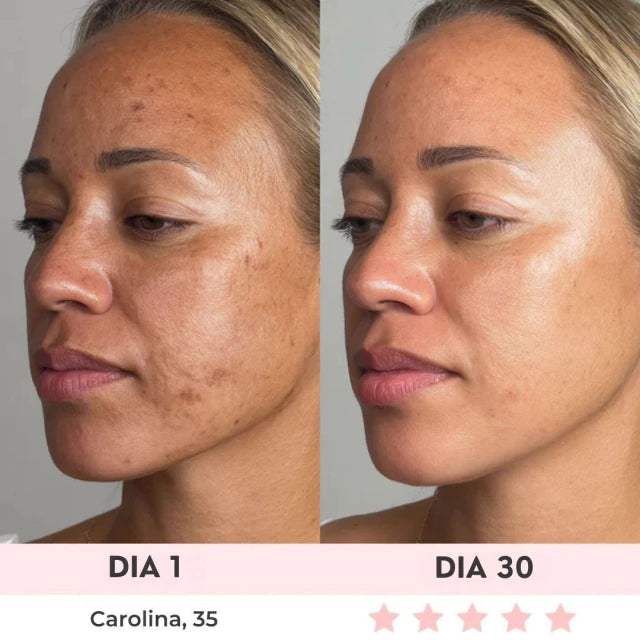 Lift Facial com HIFU – Tecnologia que Ativa o Colágeno e Rejuvenesce o Rosto