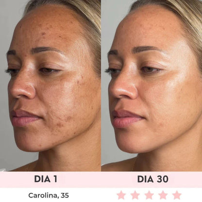 Lift Facial com HIFU – Tecnologia que Ativa o Colágeno e Rejuvenesce o Rosto