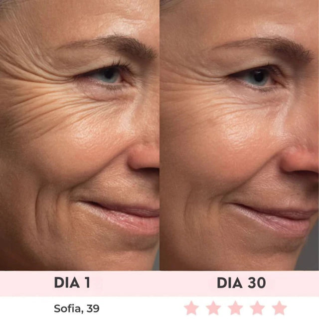 Lift Facial com HIFU – Tecnologia que Ativa o Colágeno e Rejuvenesce o Rosto