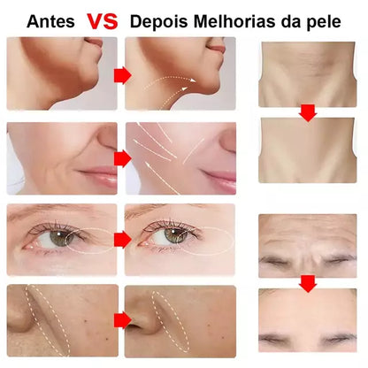 Mini Hifu Ultrassom Portátil Microfocado Para O Rosto