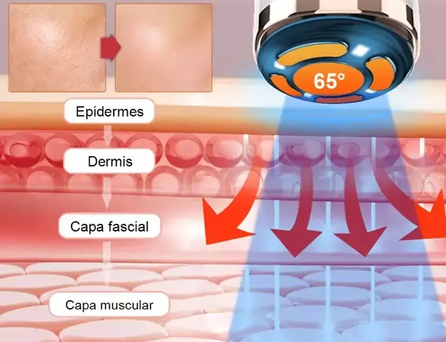 Mini Hifu Ultrassom Portátil Microfocado Para O Rosto