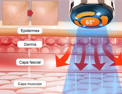 Mini Hifu Ultrassom Portátil Microfocado Para O Rosto